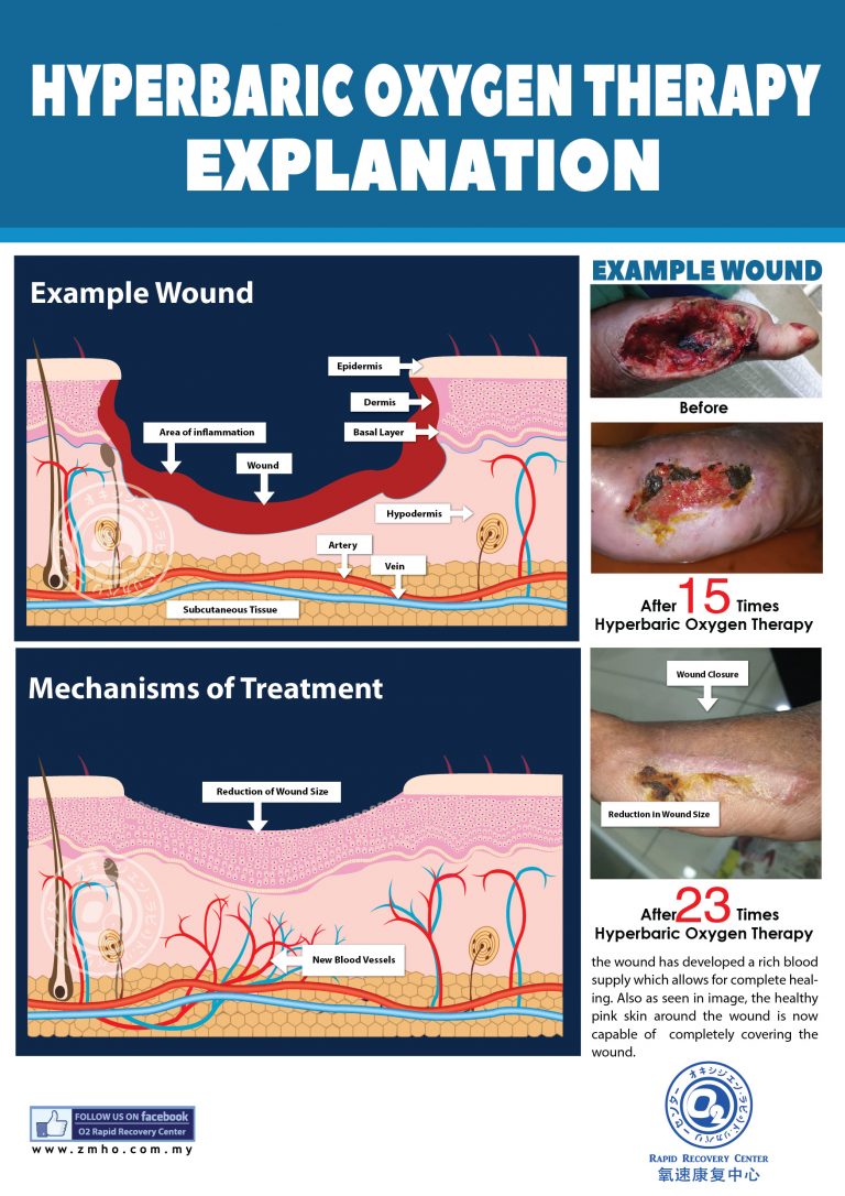 ZM Hyperbaric Oxygen Therapy HBOT